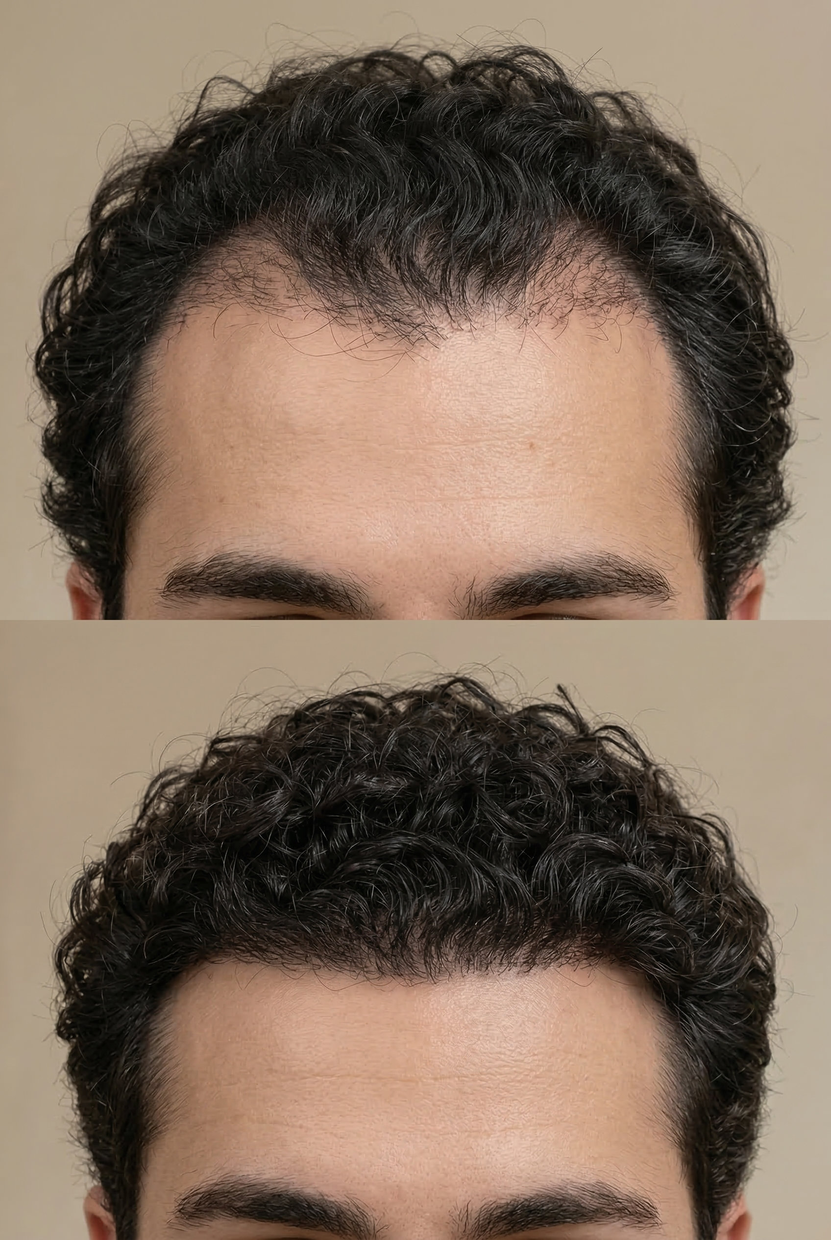 vital-hair-barcelona-caso-3